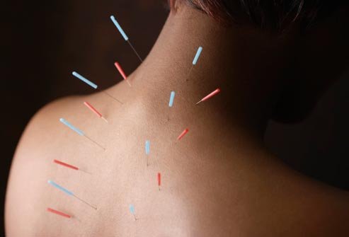 Tratamiento Dolor con Acupuntura