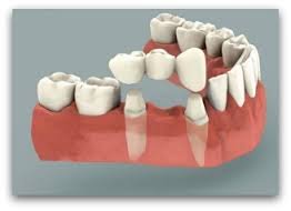 Protesis dental